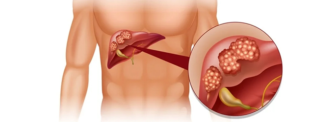 Oncologist for Women Cancers in Vile Parle