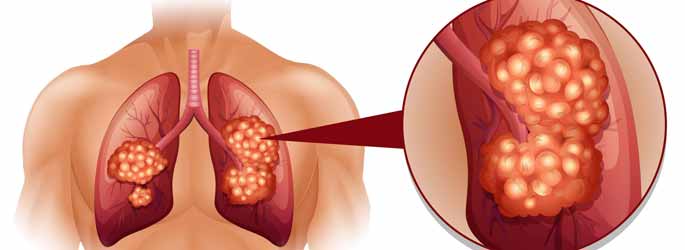 Lung Cancer Doctor in Vile Parle